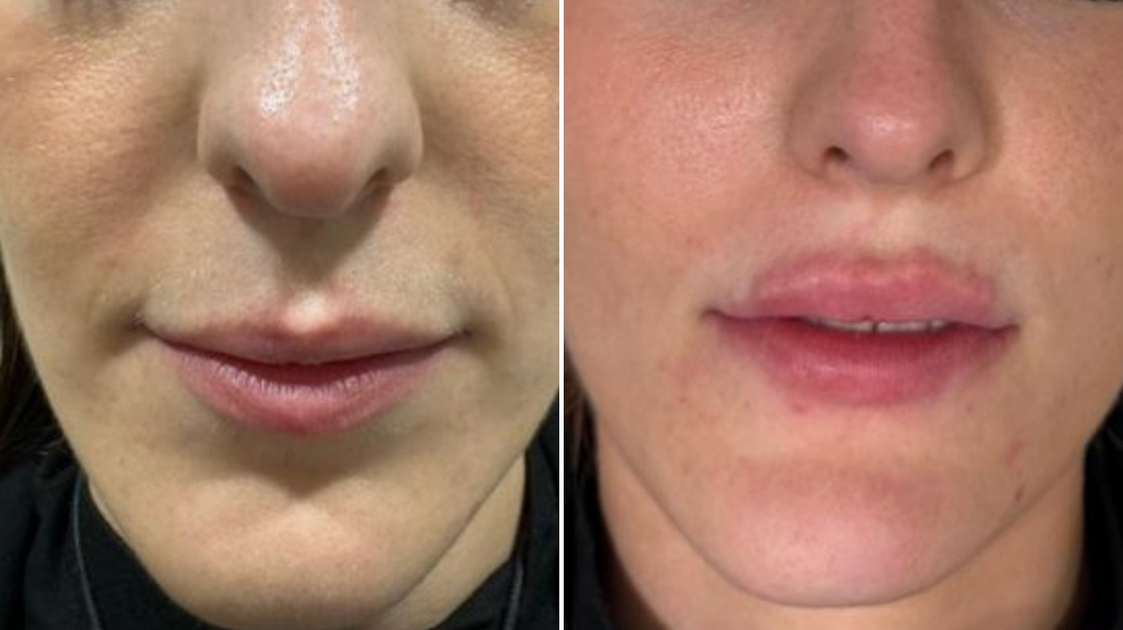 before after dermal filler