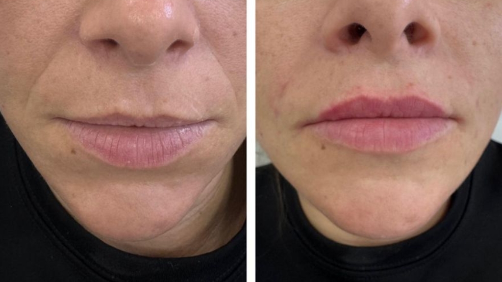 dermal filler before and afters