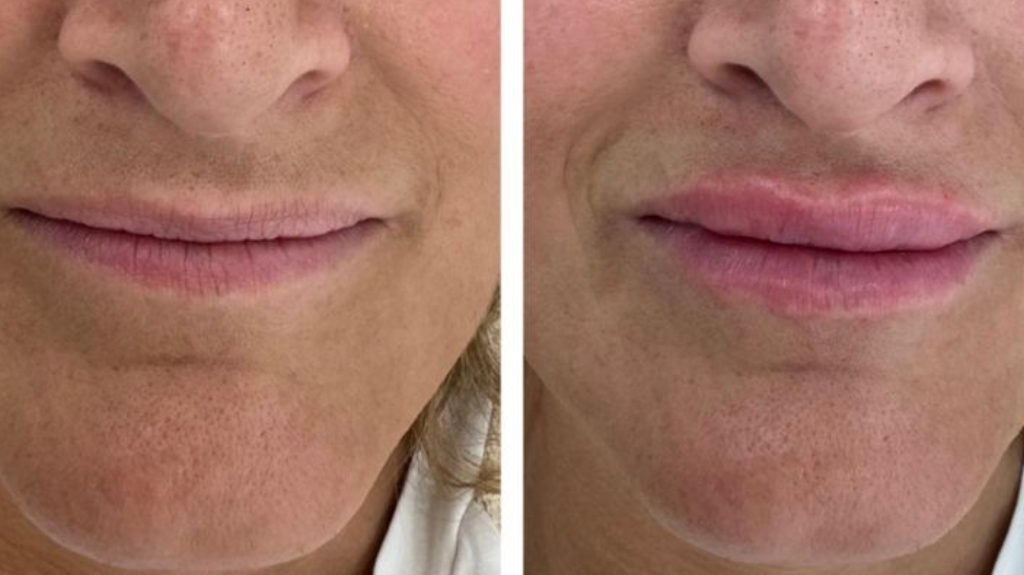 Dermal Fillers in Bromley