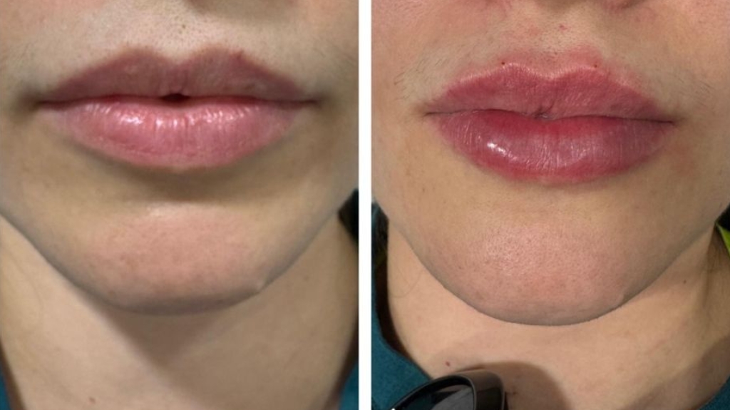 Dermal Fillers in Bromley