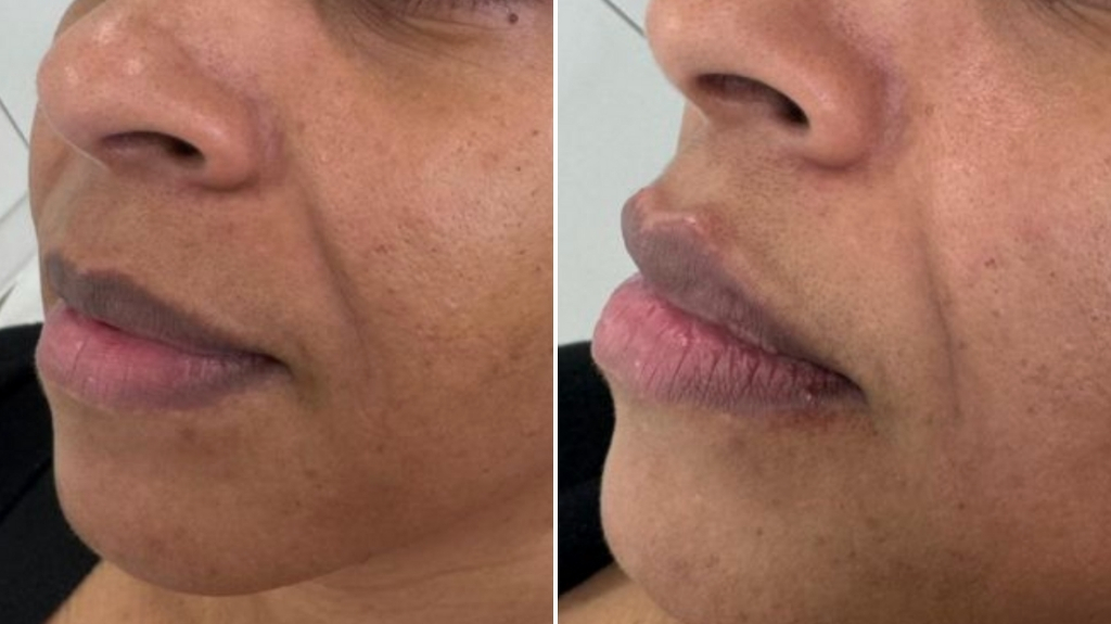 Dermal Fillers in Bromley