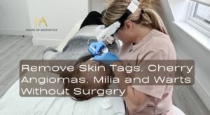 Remove Skin Tags, Cherry Angiomas, Milia and Warts Without Surgery in Bromley