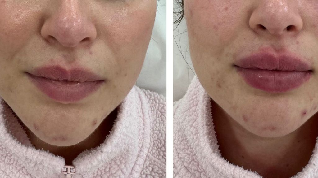 Dermal Fillers in Bromley