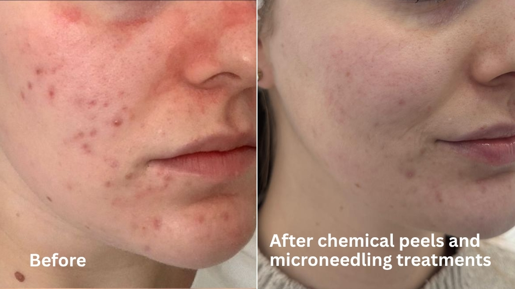 Marianne's acne treatment