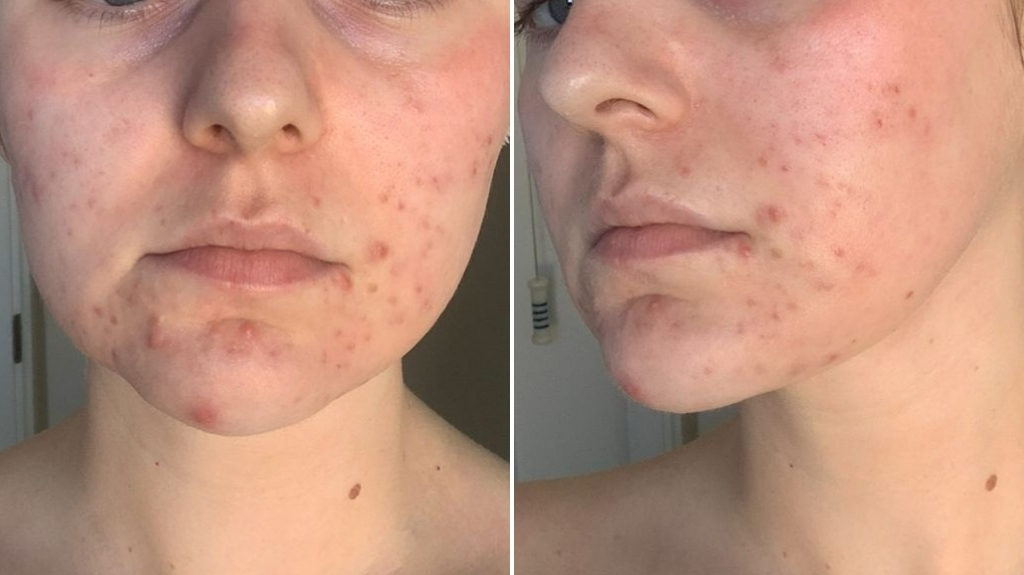 Acne and scar treatment