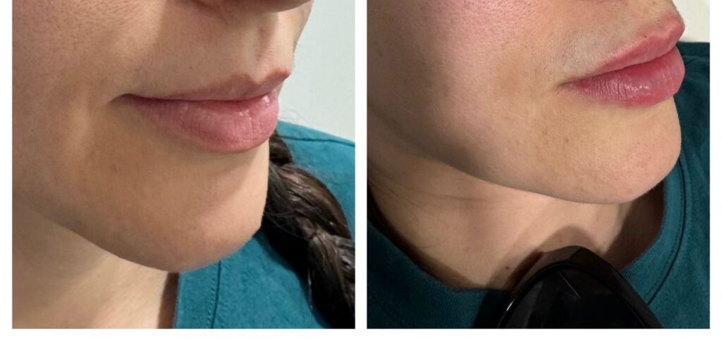 Dermal Fillers in Bromley