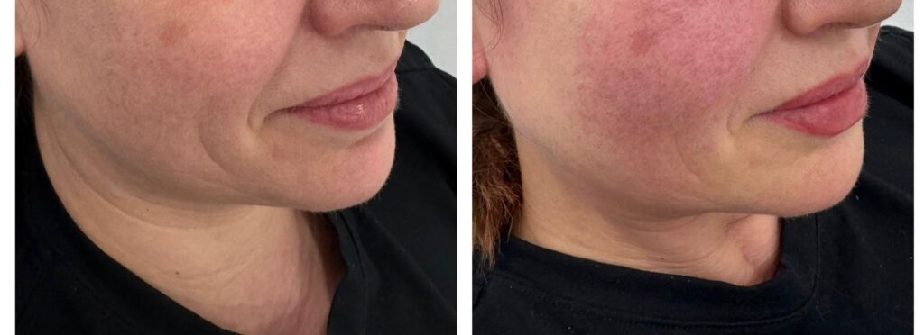 Dermal Fillers in Bromley