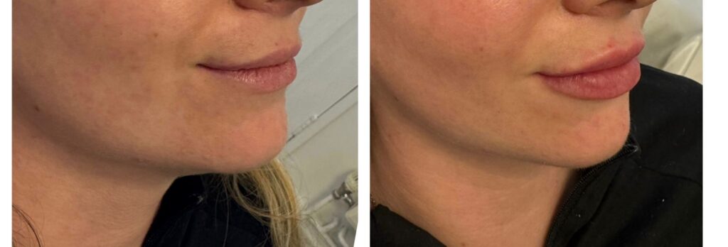 Dermal Fillers in Bromley