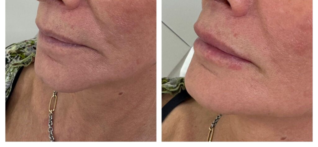 Dermal Fillers in Bromley