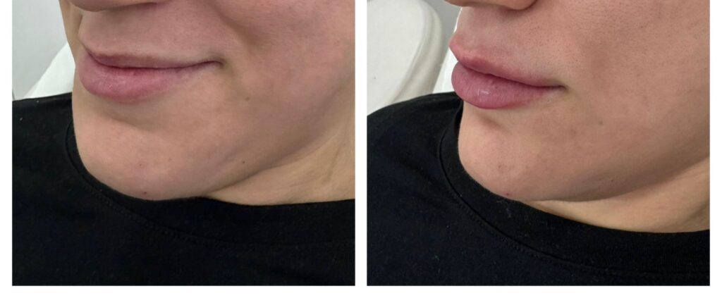 Dermal Fillers in Bromley