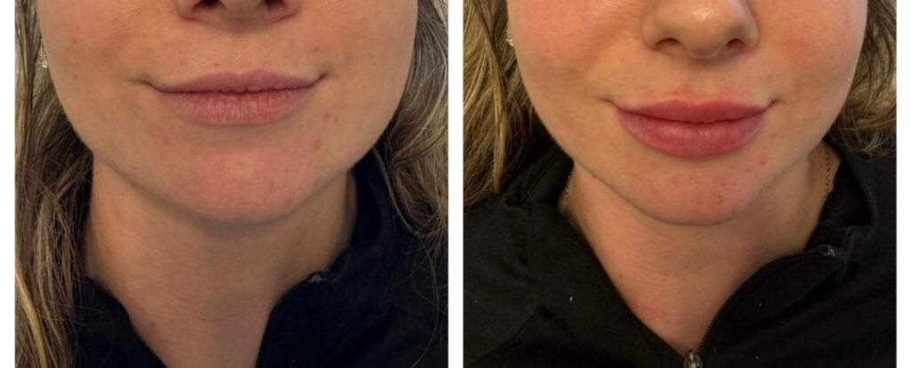 Dermal Fillers in Bromley