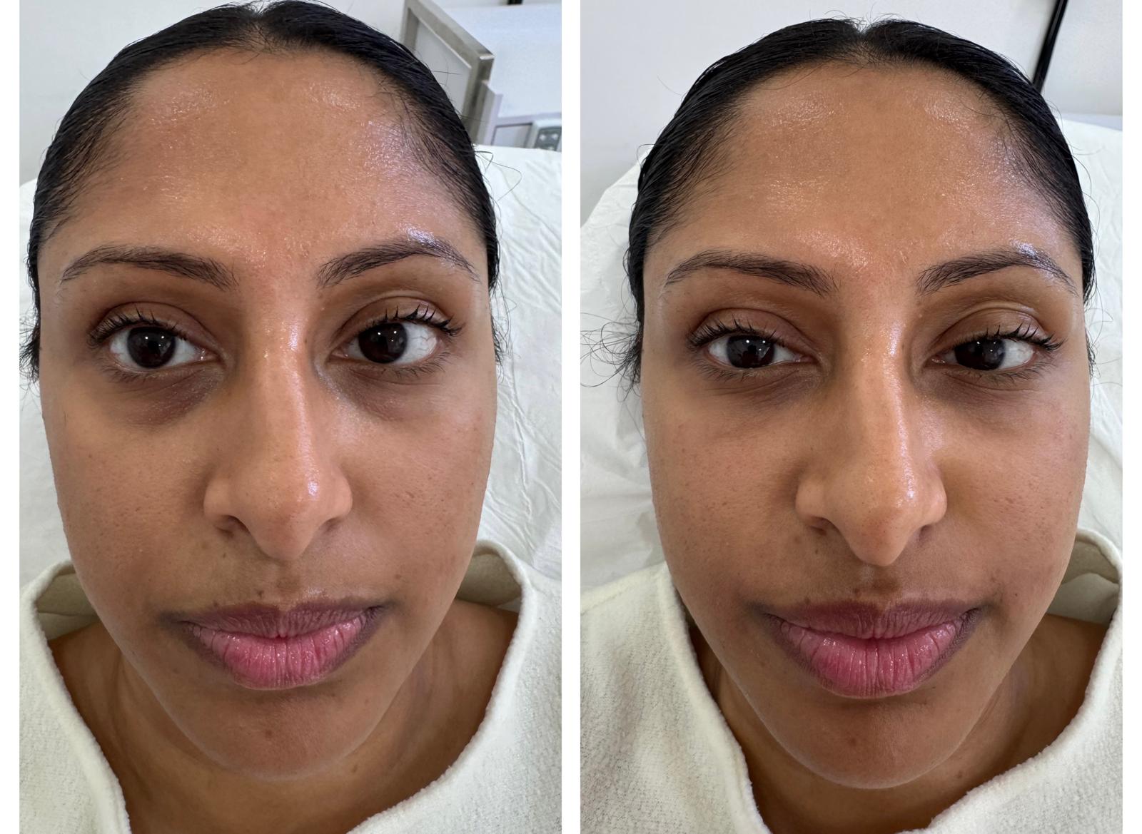 Polynucleotides Before and After | under her eyes and nasolabial folds