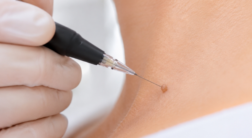Skin Tag Removal: Costs, Methods, and What to Expect in the UK in 2026