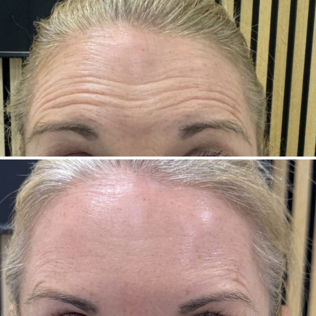 Fine Lines and Wrinkles