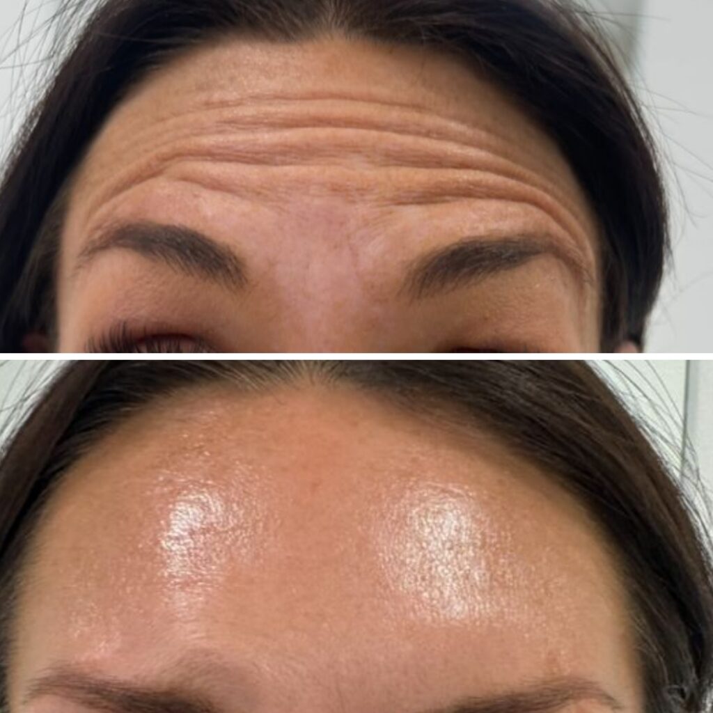 Fine Lines and Wrinkles