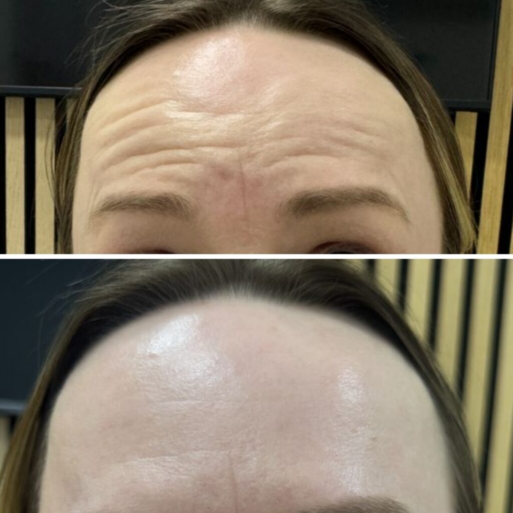 Fine Lines and Wrinkles