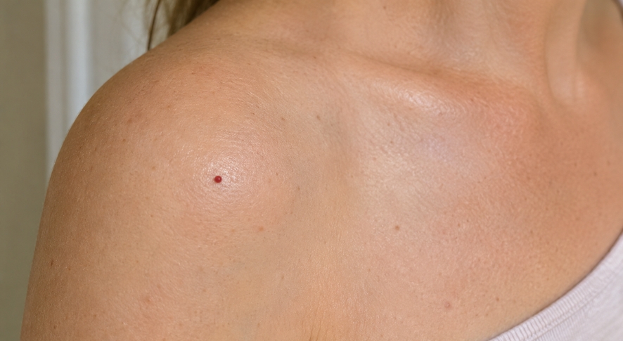 Cherry Angiomas Why Red Moles Appear on Your Body and How to Remove Them