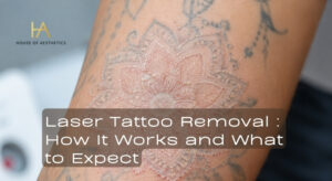 Laser Tattoo Removal Explained How It Works, What It Costs, and What to Expect