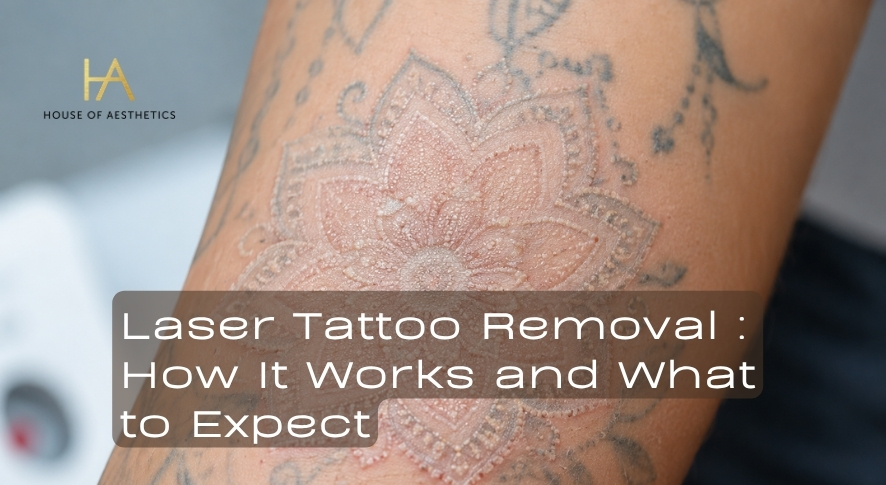 Laser Tattoo Removal Explained How It Works, What It Costs, and What to Expect