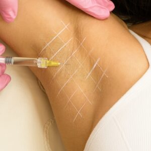 Anti-Wrinkle Injections for Hyperhidrosis