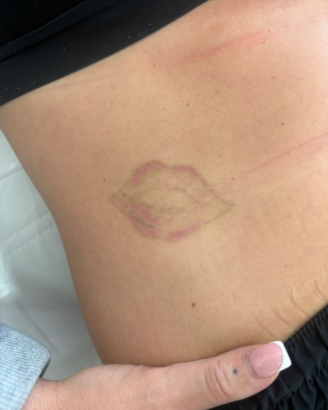 tattoo removal after