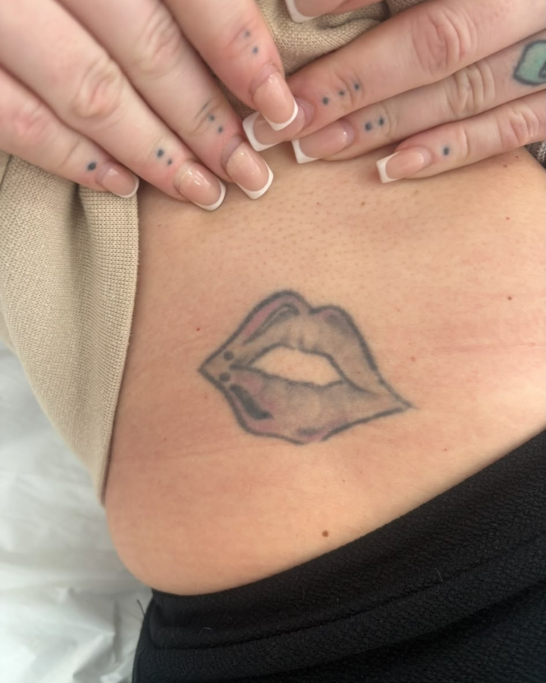 Tattoo Removal Bromley tattoo removal before
