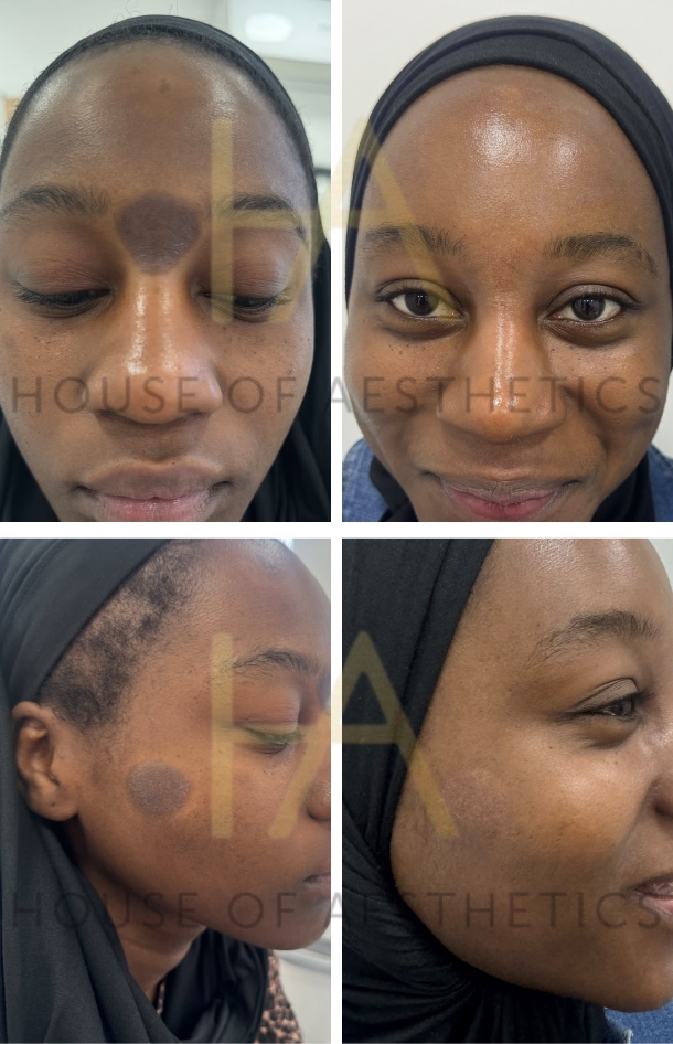 cosmelan before and after