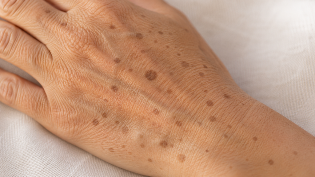 Melasma, Sun Damage or Age Spots? Identifying Your Pigmentation Before Treating It