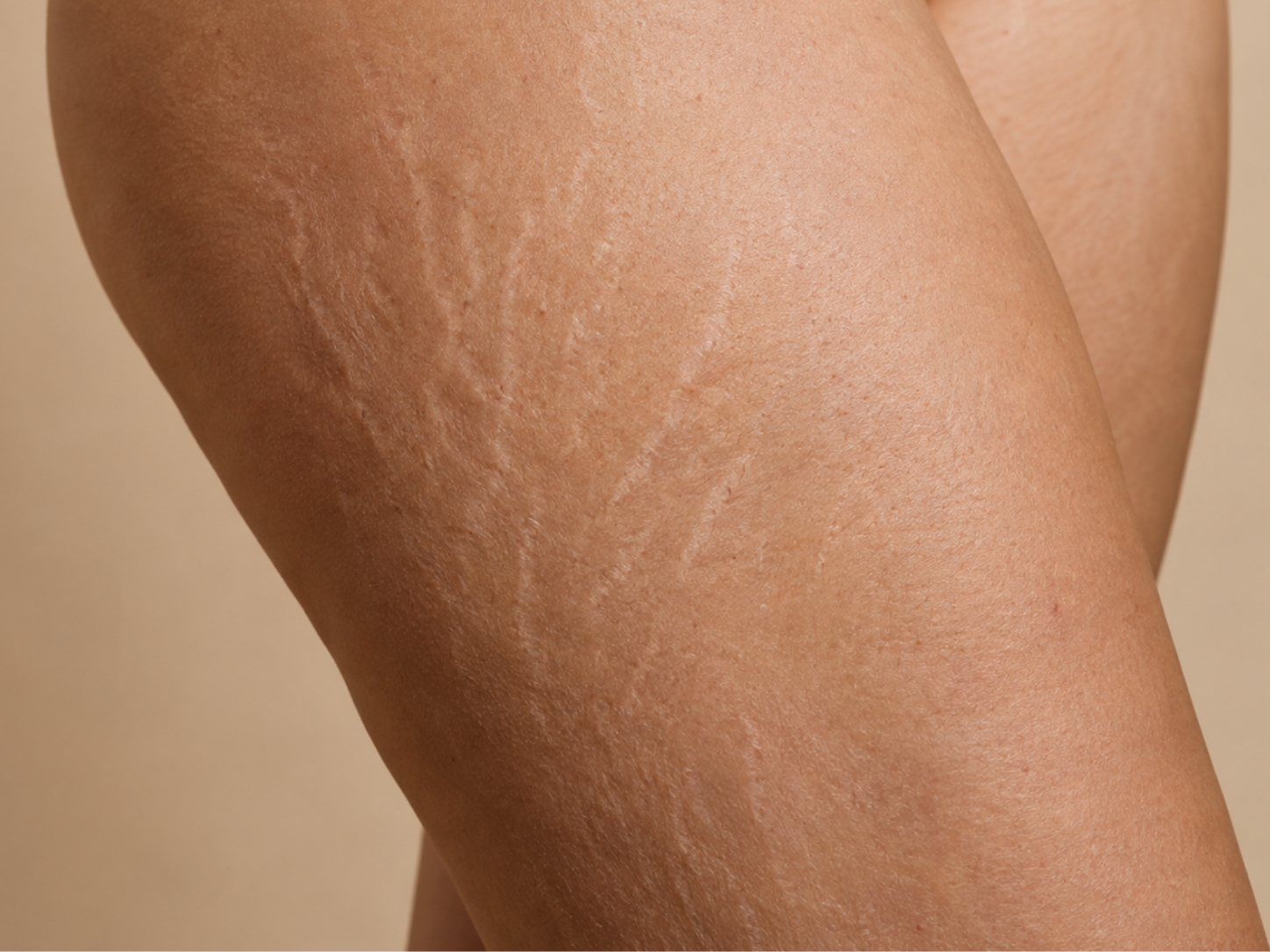 Close-up of skin on the hip showing faint stretch marks