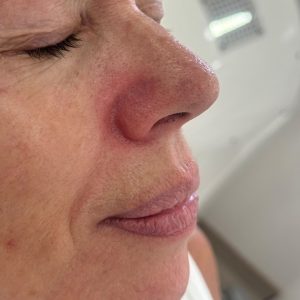 IPL for veins after