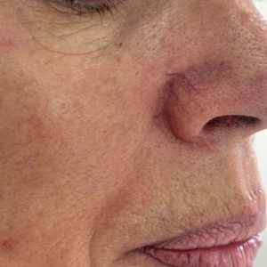 IPL for veins before