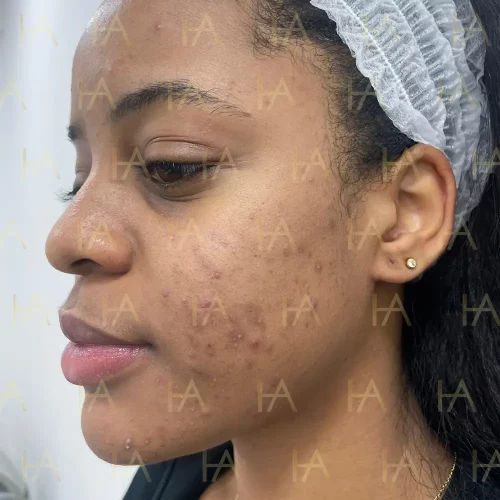 Pigmentation Removal Bromley South London